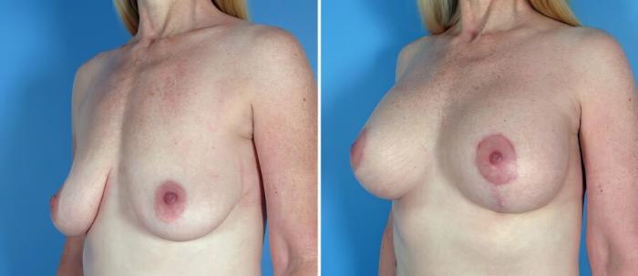 Breast Augmentation with Lift Before & After Case 18066