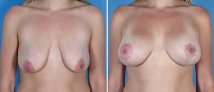 Breast Augmentation with Lift Before & After Case 18069