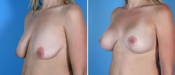 Breast Augmentation with Lift Before & After Case 18069