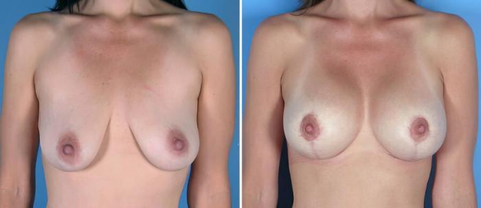 Breast Augmentation with Lift Before & After Case 18072