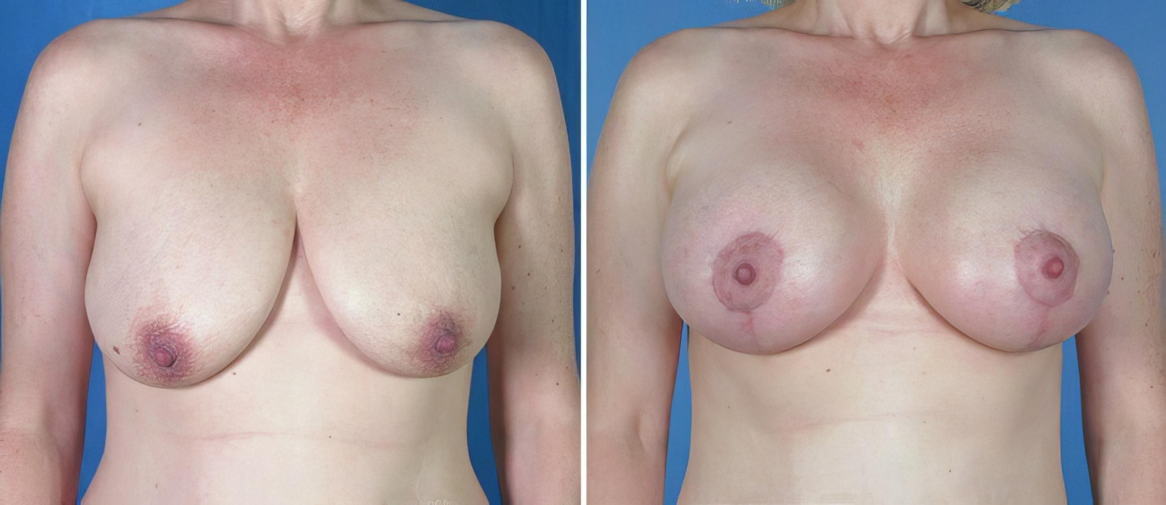 Breast Augmentation with Lift Before & After Case 18075
