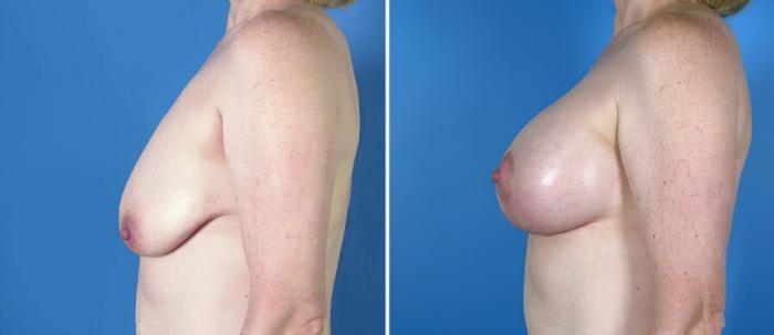 Breast Augmentation with Lift Before & After Case 18075
