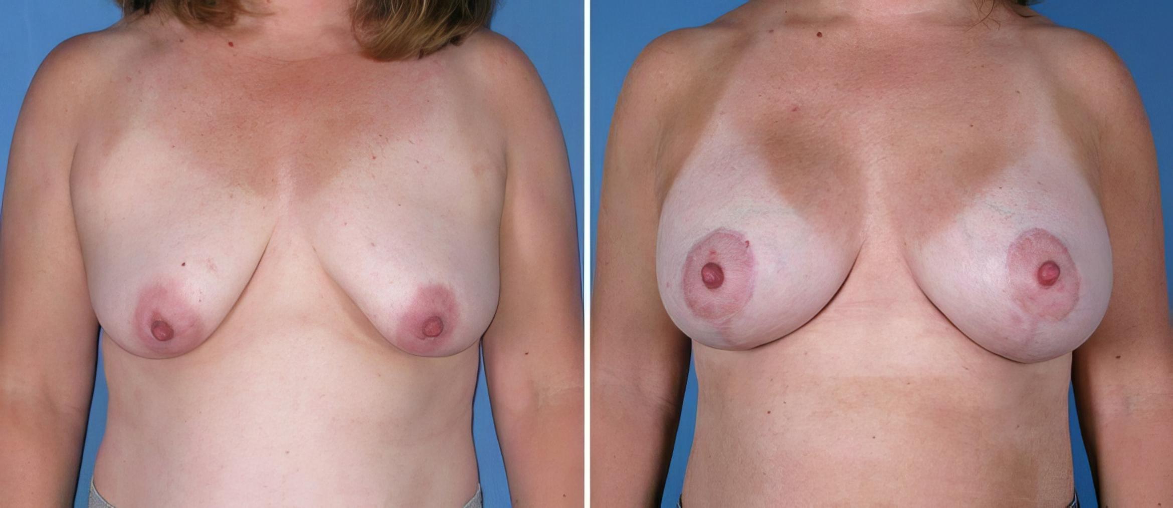 Breast Augmentation with Lift Before & After Case 18085