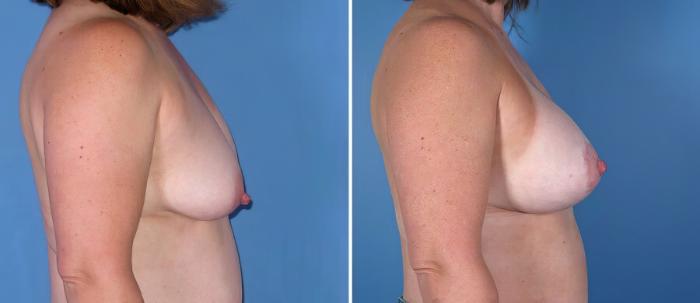 Breast Augmentation with Lift Before & After Case 18085