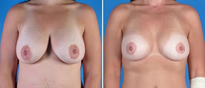 Breast Augmentation with Lift Before & After Case 18088