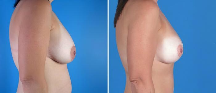 Breast Augmentation with Lift Before & After Case 18088