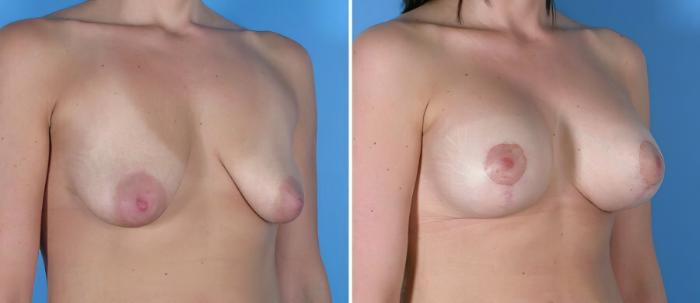 Breast Augmentation with Lift Before & After Case 18098