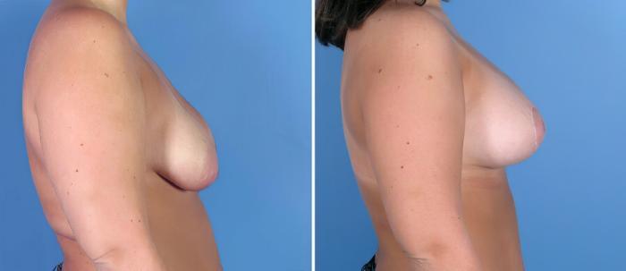 Breast Augmentation with Lift Before & After Case 18101