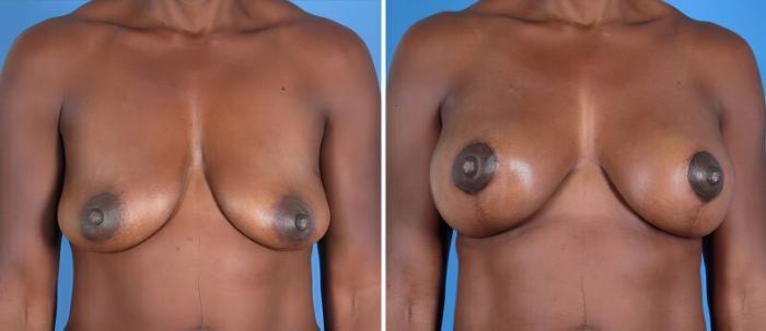 Breast Augmentation with Lift Before & After Case 25498