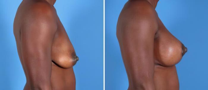 Breast Augmentation with Lift Before & After Case 25498
