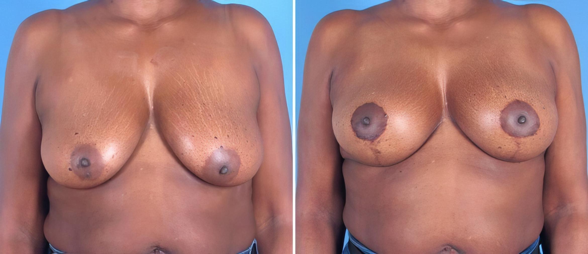 Breast Augmentation with Lift Before & After Case 25794