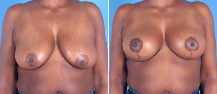Breast Augmentation with Lift Before & After Case 25794