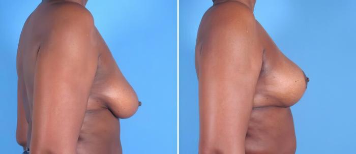 Breast Augmentation with Lift Before & After Case 25794