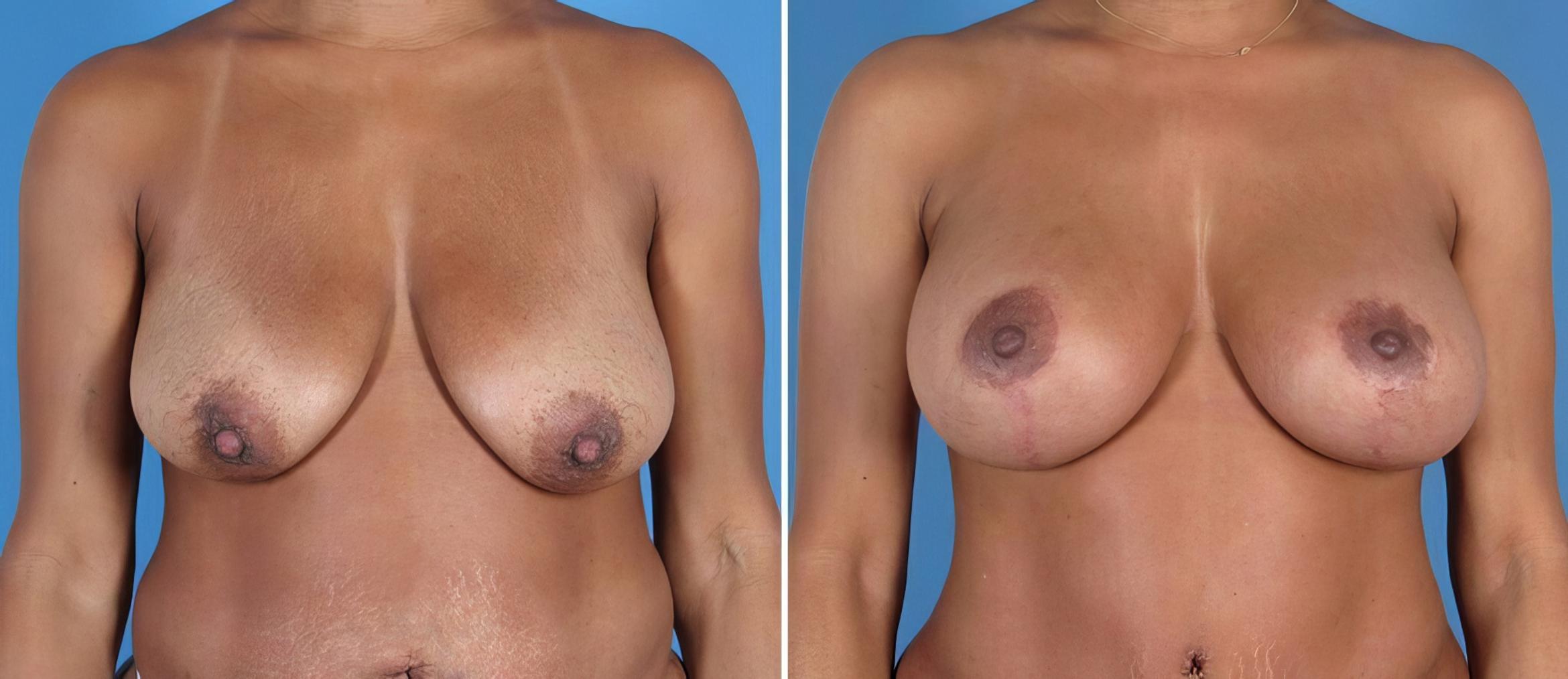 Breast Augmentation with Lift Before & After Case 26021