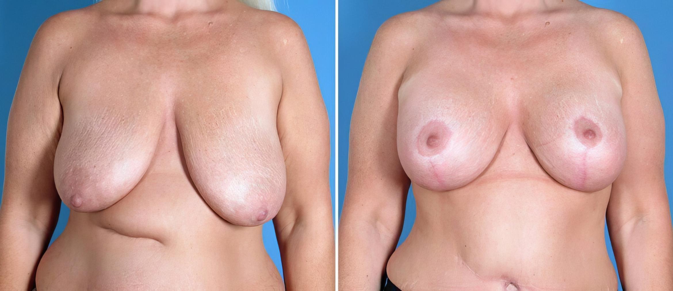 Breast Augmentation with Lift Before & After Case 26212
