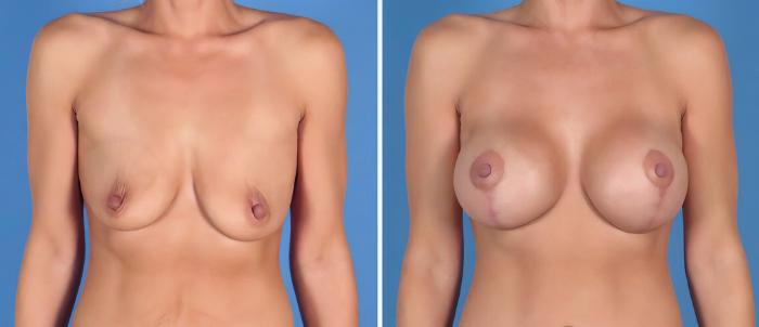 Breast Augmentation with Lift Before & After Case 27026