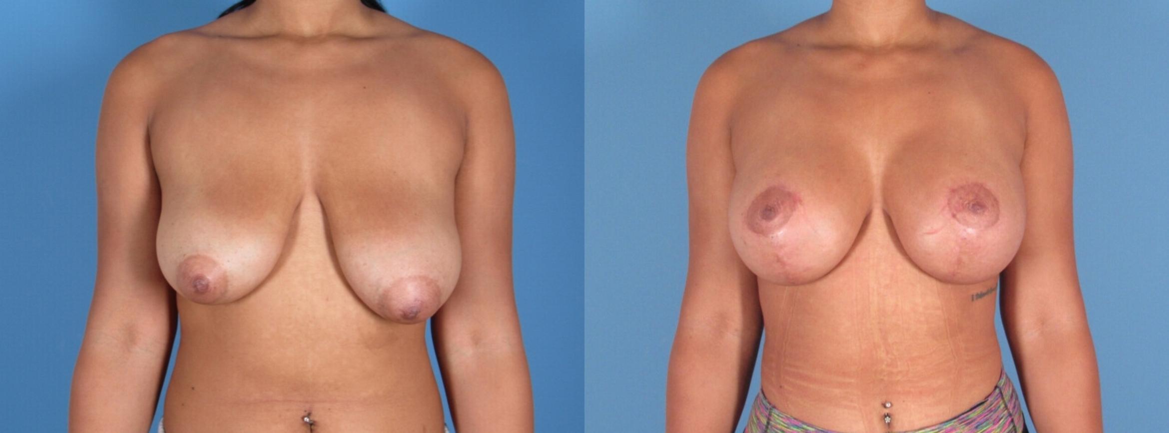 Breast Augmentation with Lift Before & After Case 28309