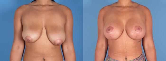 Breast Augmentation with Lift Before & After Case 28309