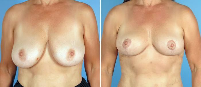 Breast Implant Revision Before & After Case 17511