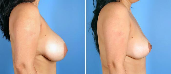 Breast Implant Revision Before & After Case 17633