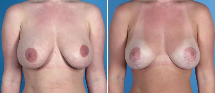 Breast Implant Revision Before & After Case 18095