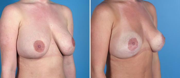 Breast Implant Revision Before & After Case 18095