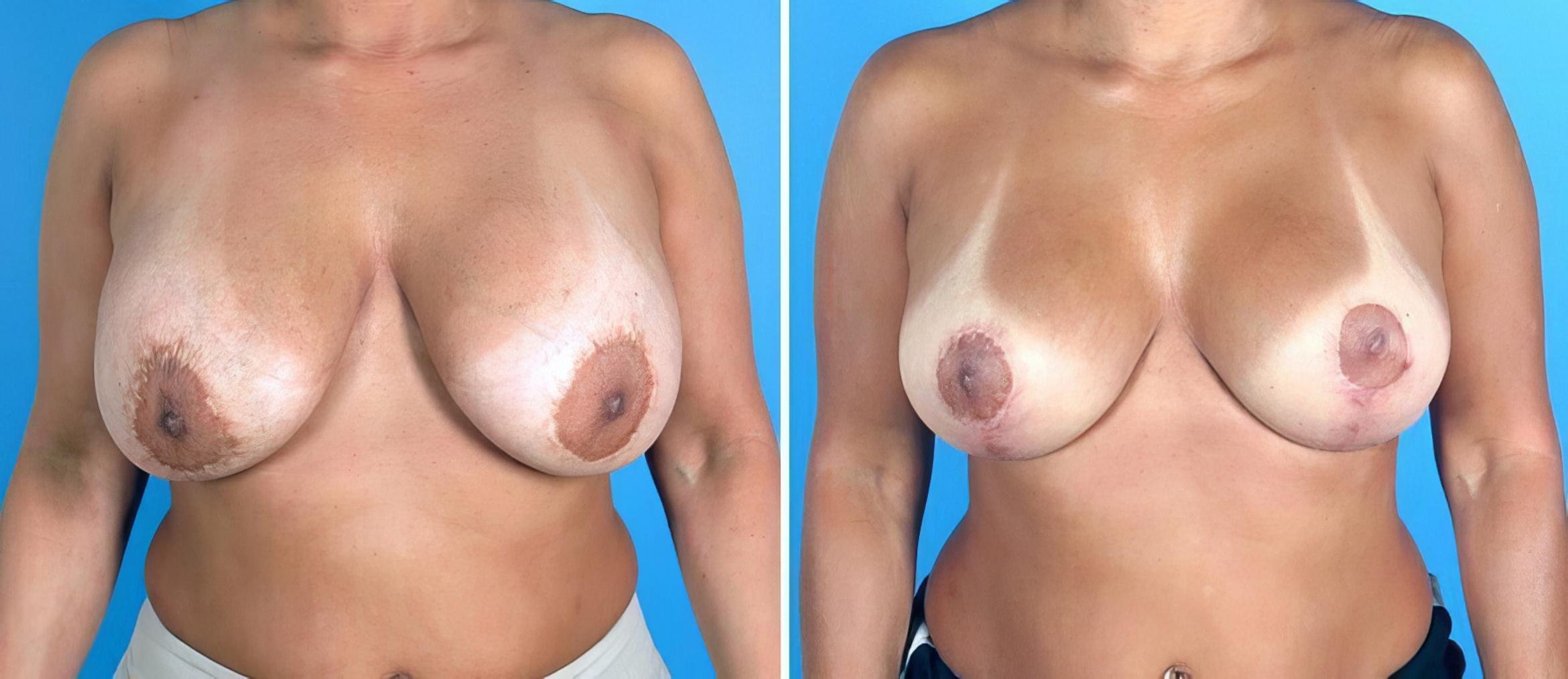 Breast Implant Revision Before & After Case 19240