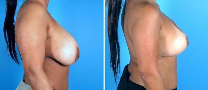 Breast Implant Revision Before & After Case 19240