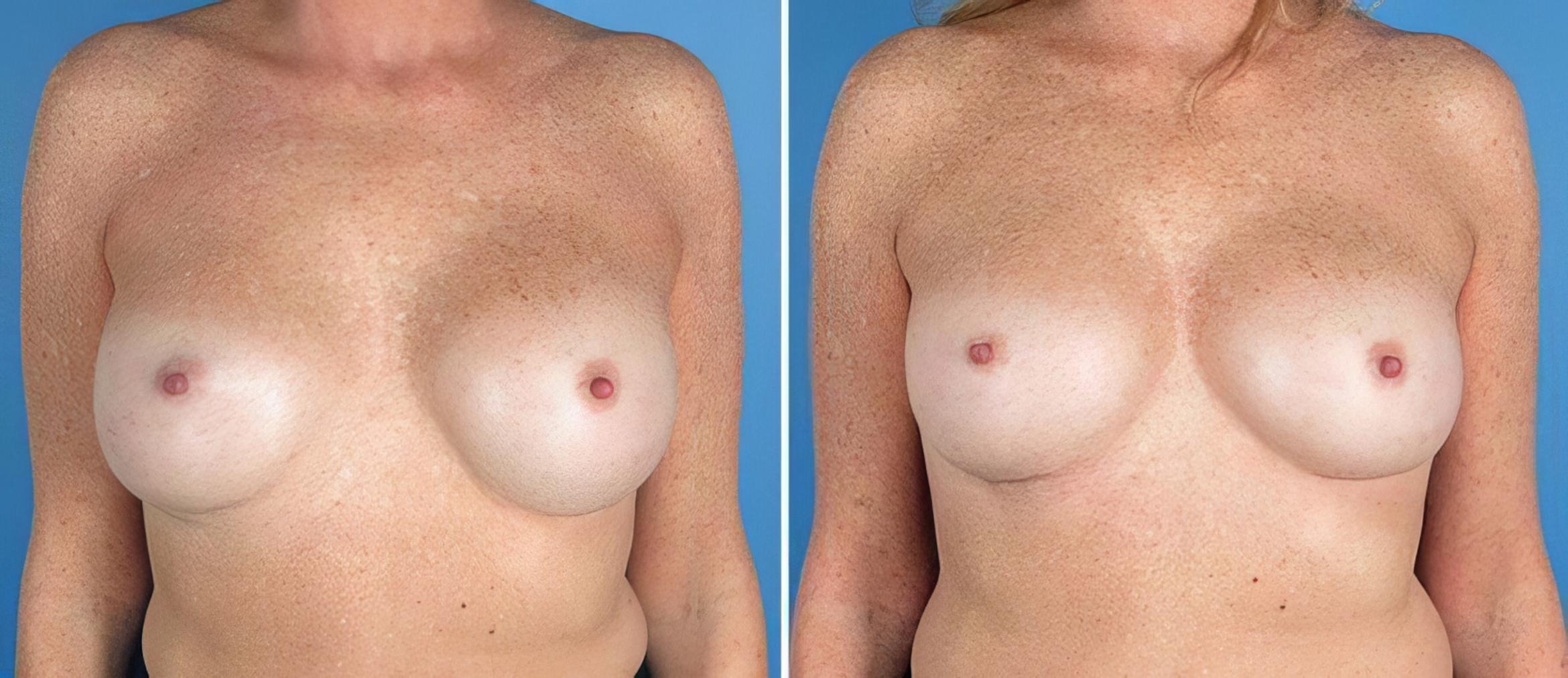 Breast Implant Revision Before & After Case 19516