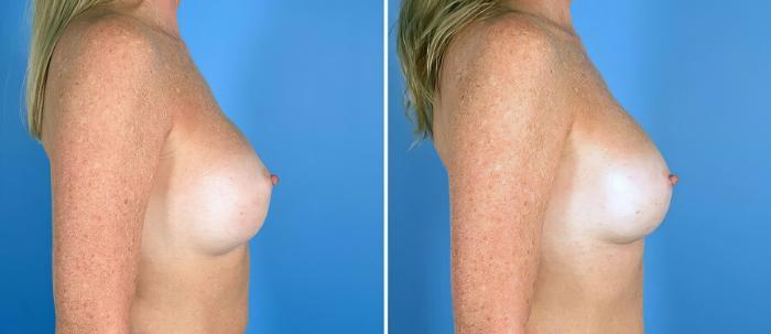 Breast Implant Revision Before & After Case 19516