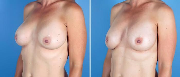 Breast Implant Revision Before & After Case 19519