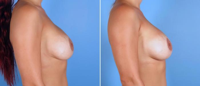 Breast Implant Revision Before & After Case 19522