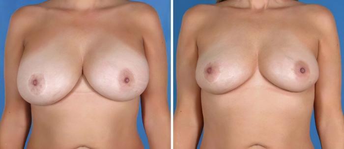 Breast Implant Revision Before & After Case 19860
