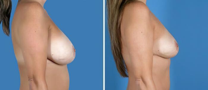 Breast Implant Revision Before & After Case 19860
