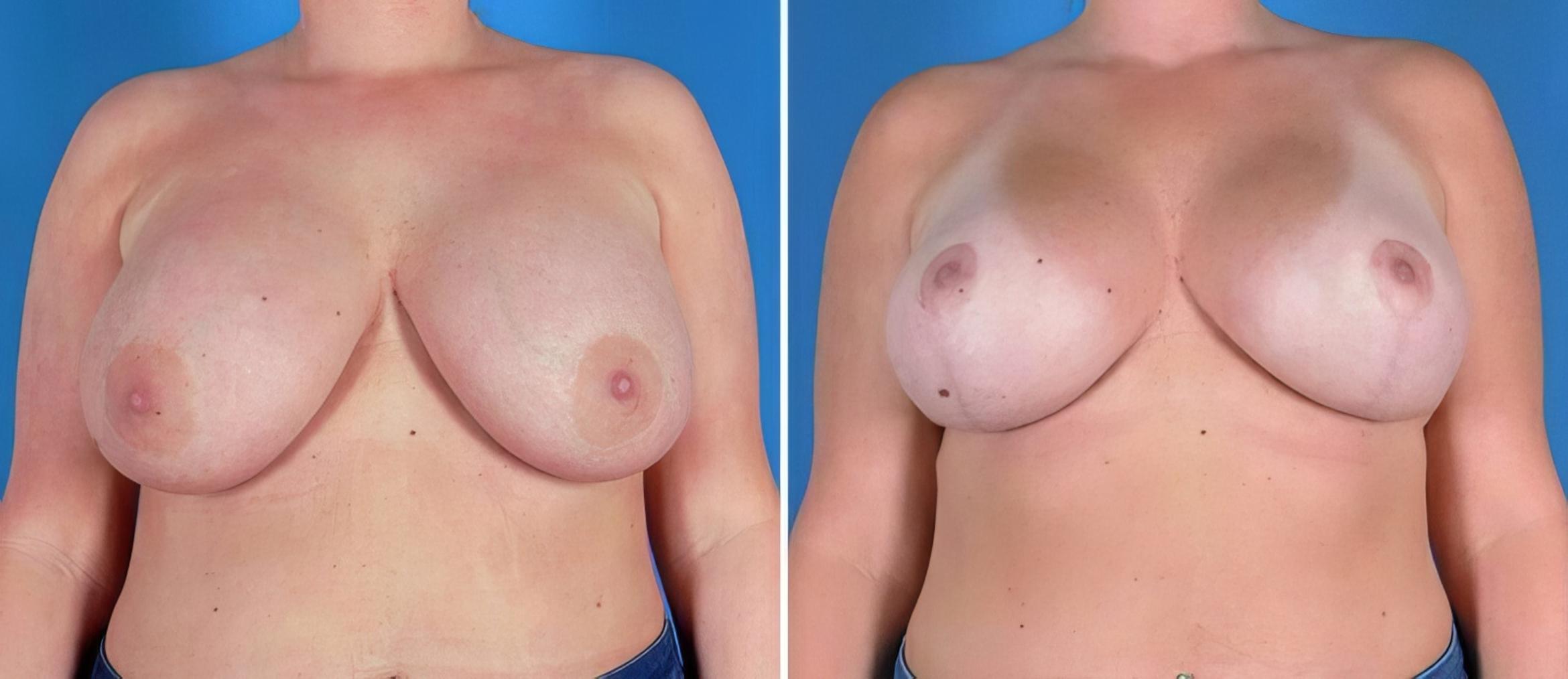 Breast Implant Revision Before & After Case 22940