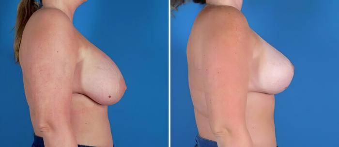 Breast Implant Revision Before & After Case 22940