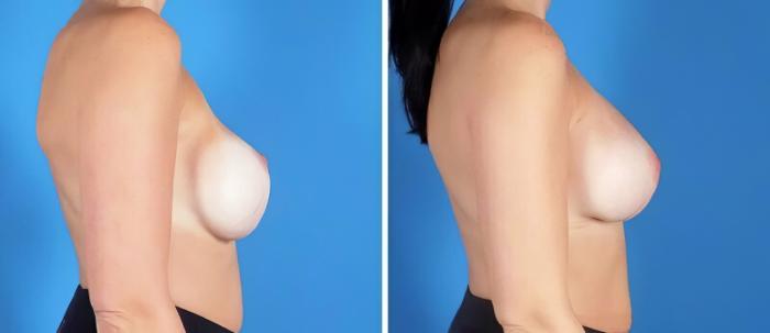 Breast Implant Revision Before & After Case 25175