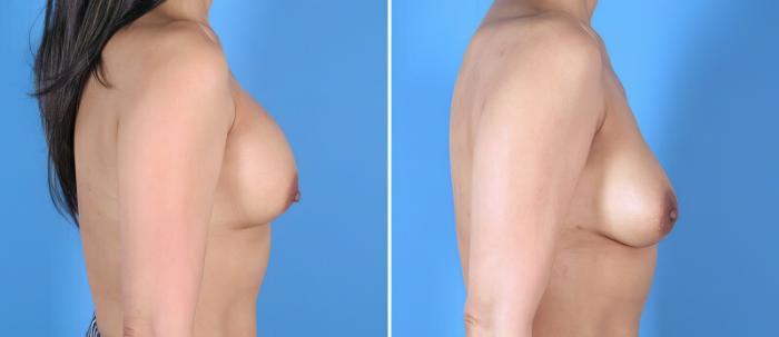Breast Implant Revision Before & After Case 25645