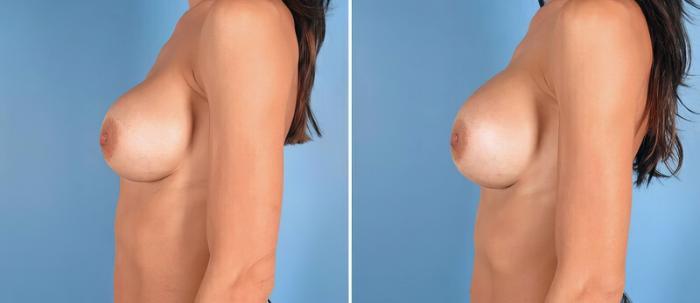 Breast Implant Revision Before & After Case 25779