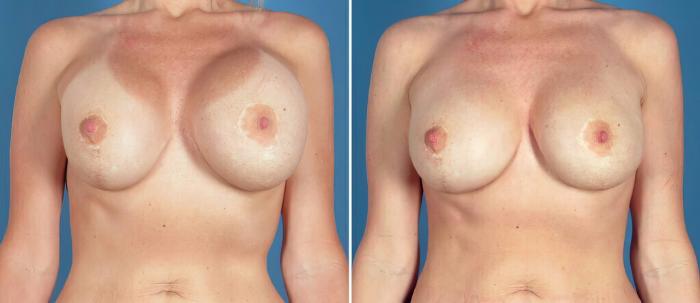 Breast Implant Revision Before & After Case 26152