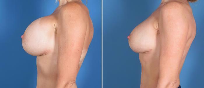Breast Implant Revision Before & After Case 26152