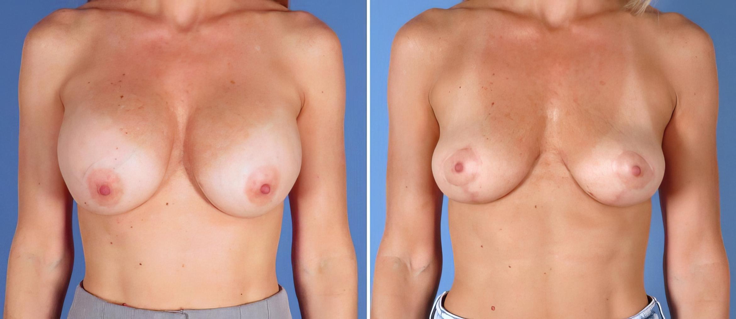 Breast Implant Revision Before & After Case 28294