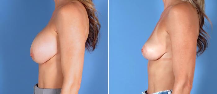 Breast Implant Revision Before & After Case 28294