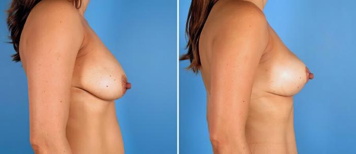 Breast Lift Before & After Case 17376