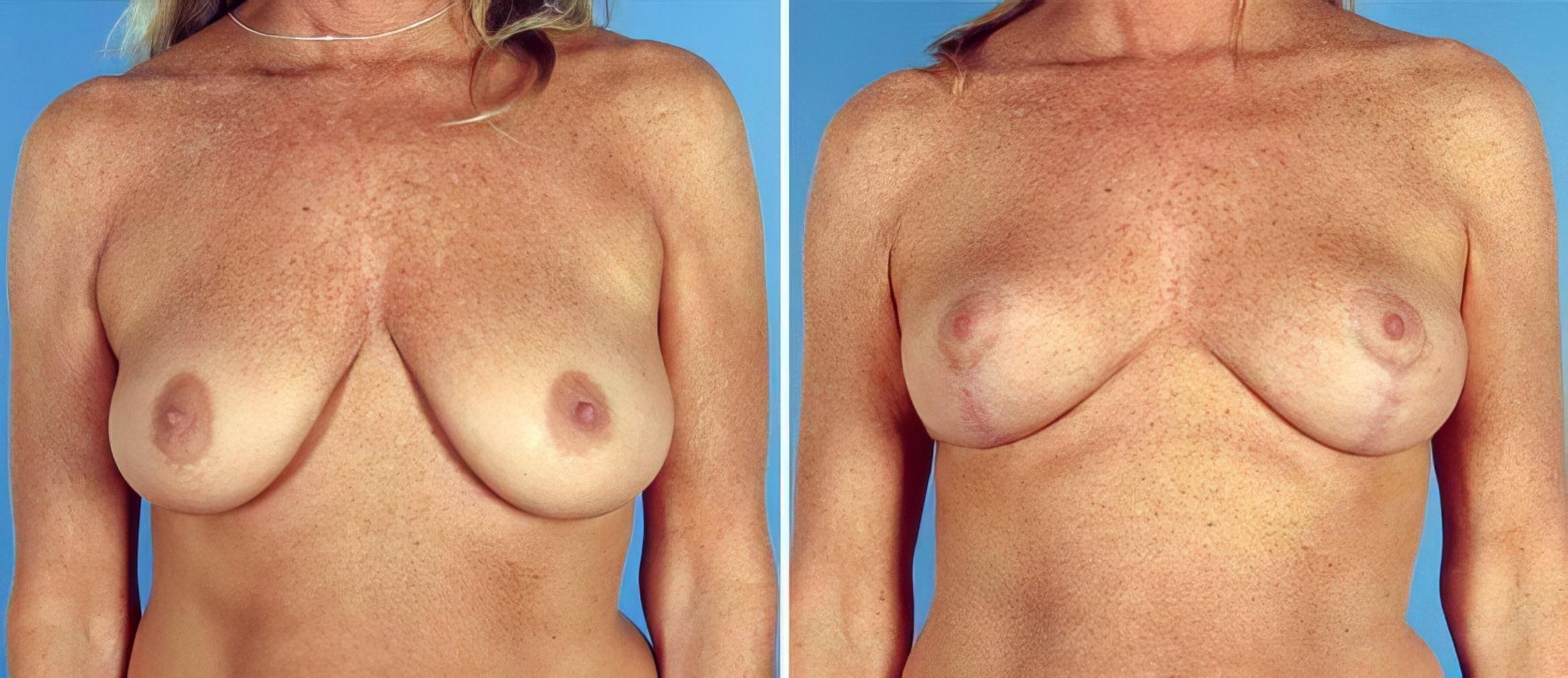 Breast Lift Before & After Case 17775