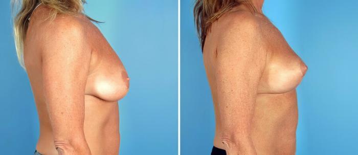 Breast Lift Before & After Case 17775