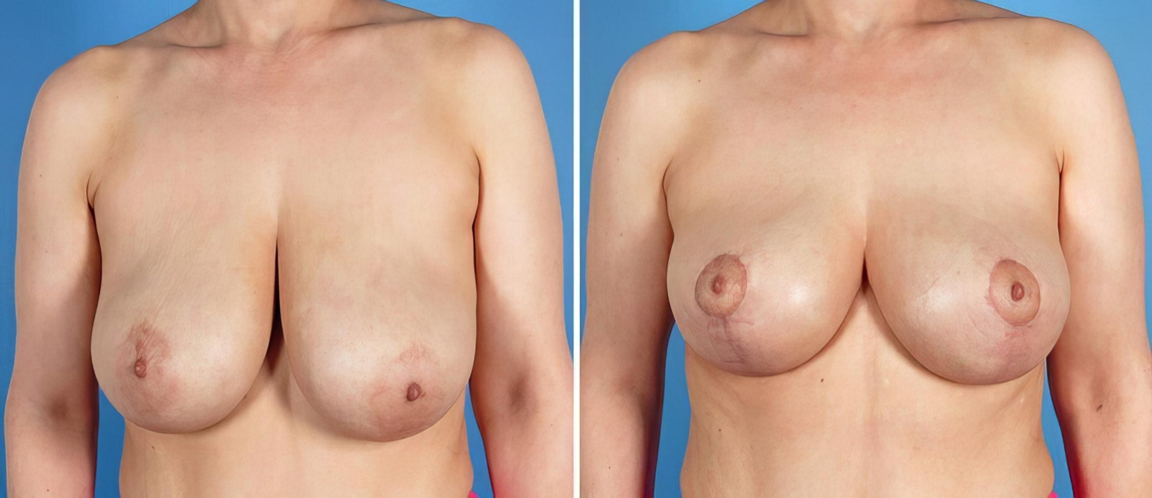 Breast Lift Before & After Case 17778