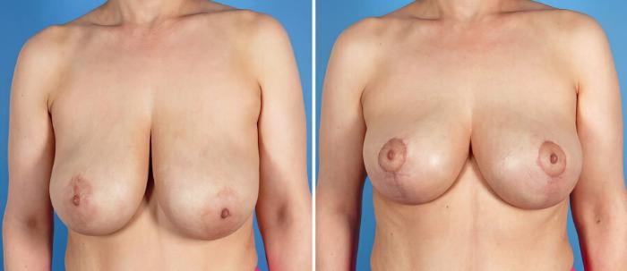 Breast Lift Before & After Case 17778