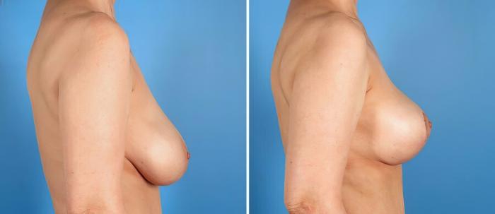 Breast Lift Before & After Case 17778