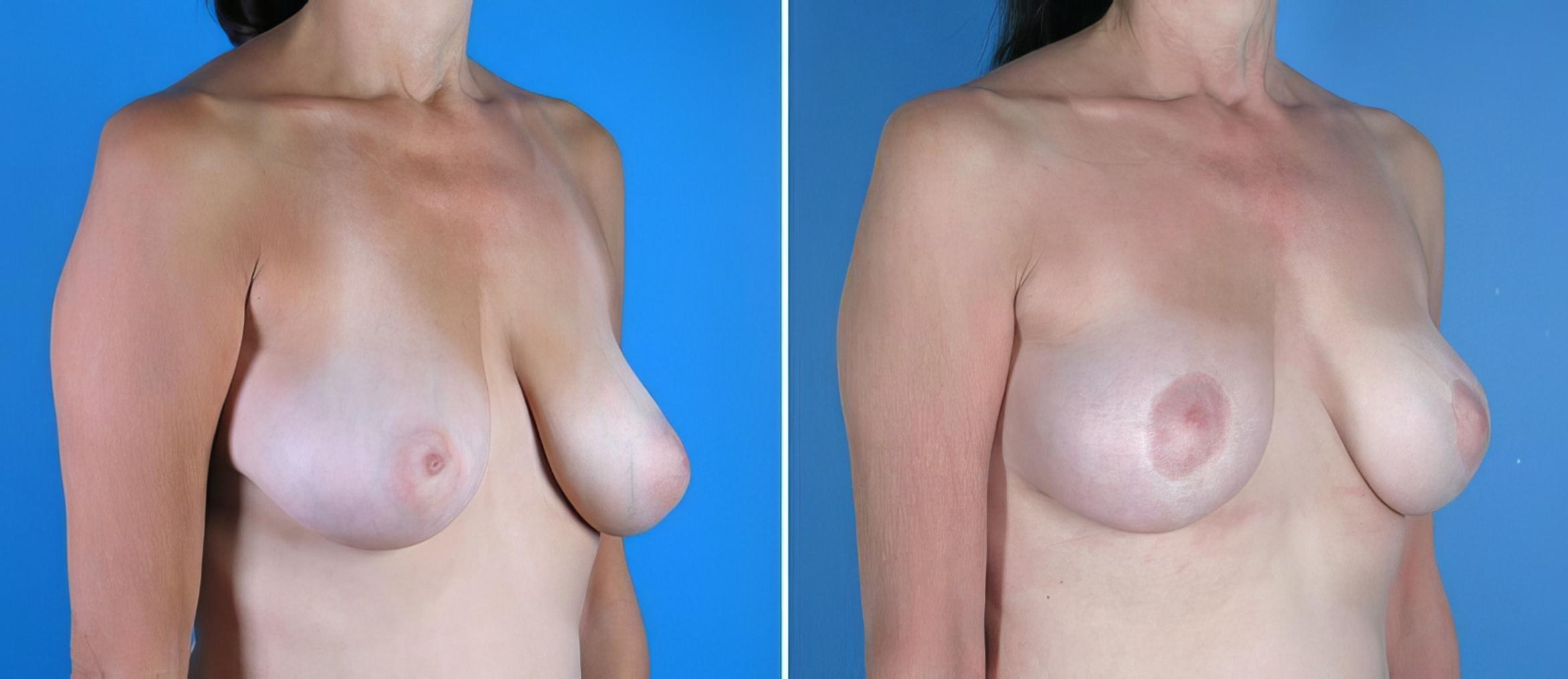 Breast Lift Before & After Case 17951